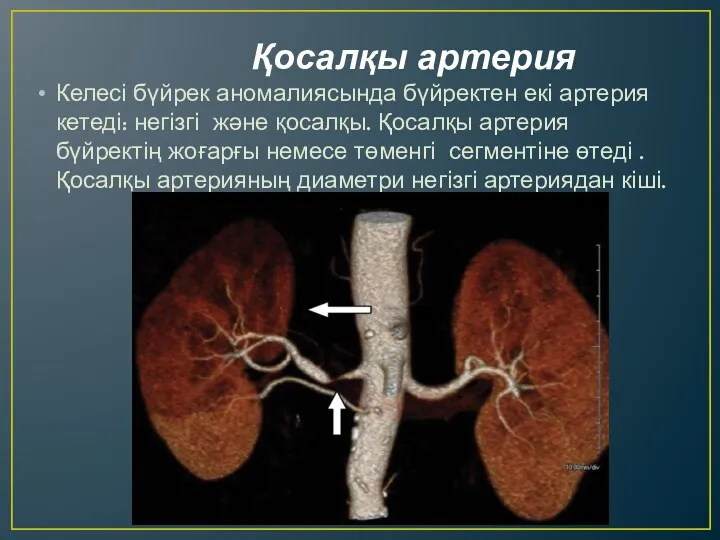Қосалқы артерия Келесі бүйрек аномалиясында бүйректен екі артерия кетеді: негізгі және қосалқы. Қосалқы