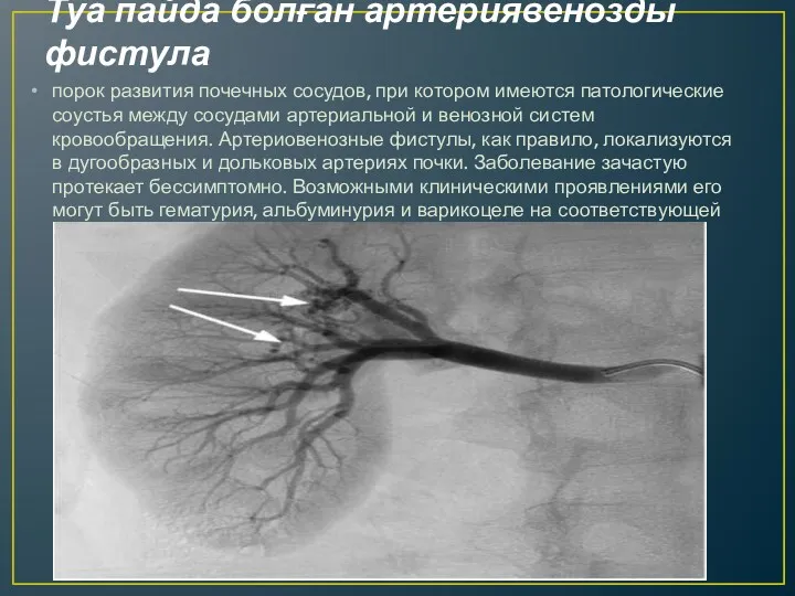 Туа пайда болған артериявенозды фистула порок развития почечных сосудов, при котором имеются патологические