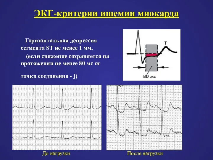 ЭКГ-критерии ишемии миокарда Горизонтальная депрессия сегмента ST не менее 1