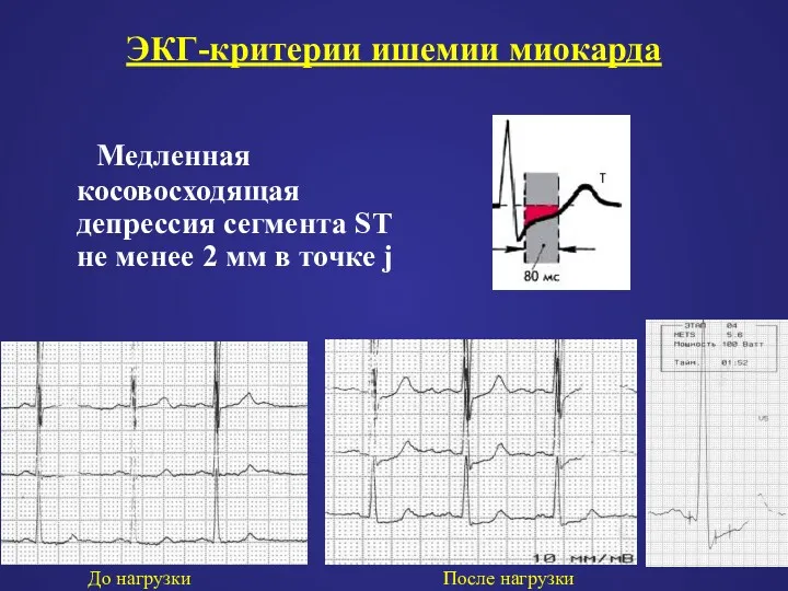 ЭКГ-критерии ишемии миокарда Медленная косовосходящая депрессия сегмента ST не менее