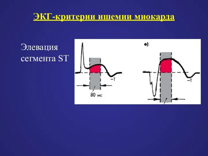 Элевация сегмента ST ЭКГ-критерии ишемии миокарда