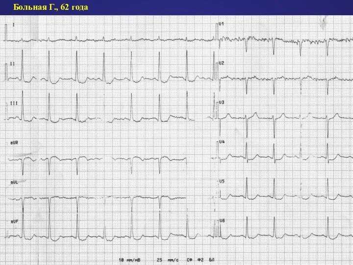 Больная Г., 62 года