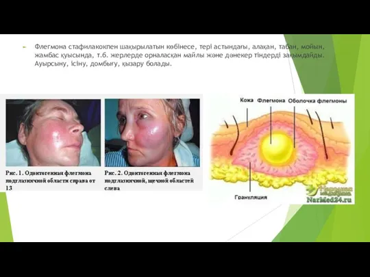 Флегмона стафилакокпен шақырылатын көбінесе, тері астындағы, алақан, табан, мойын, жамбас