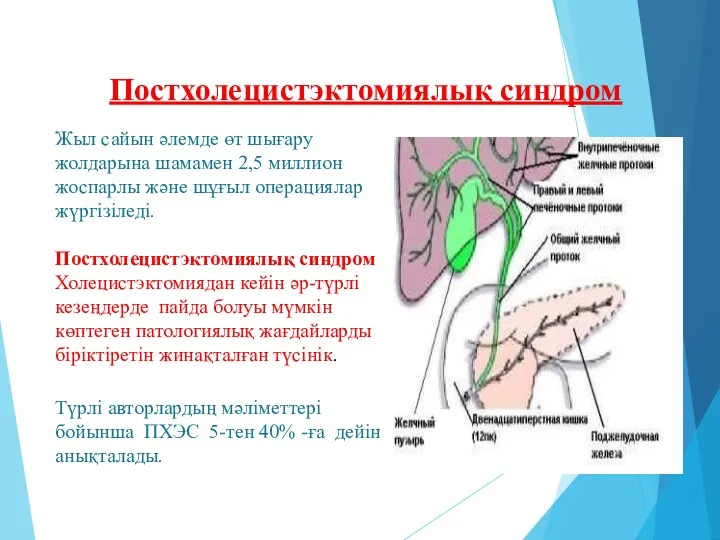 Постхолецистэктомиялық синдром Жыл сайын әлемде өт шығару жолдарына шамамен 2,5