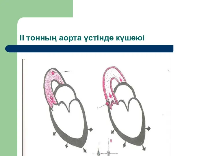 ІІ тонның аорта үстінде күшеюі