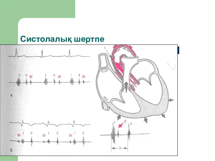 Систолалық шертпе