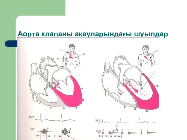 Аорта клапаны ақауларындағы шуылдар