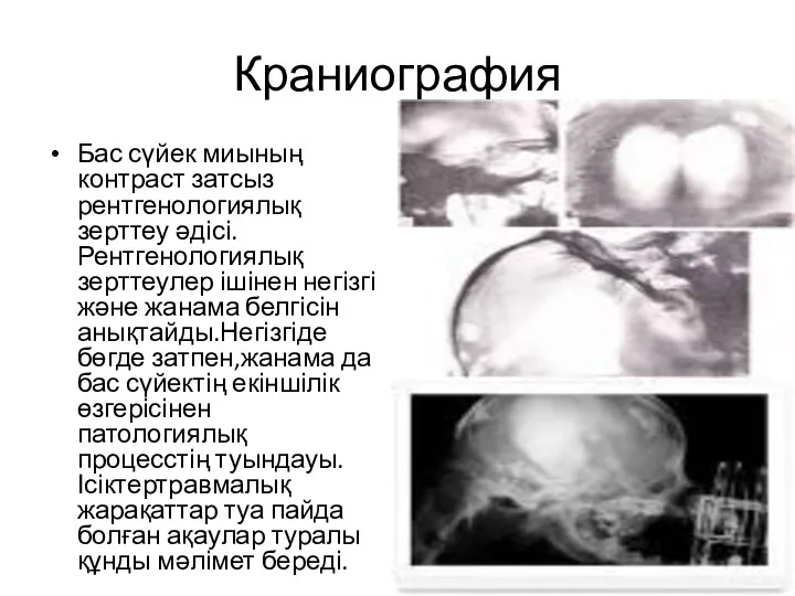 Краниография Бас сүйек миының контраст затсыз рентгенологиялық зерттеу әдісі.Рентгенологиялық зерттеулер