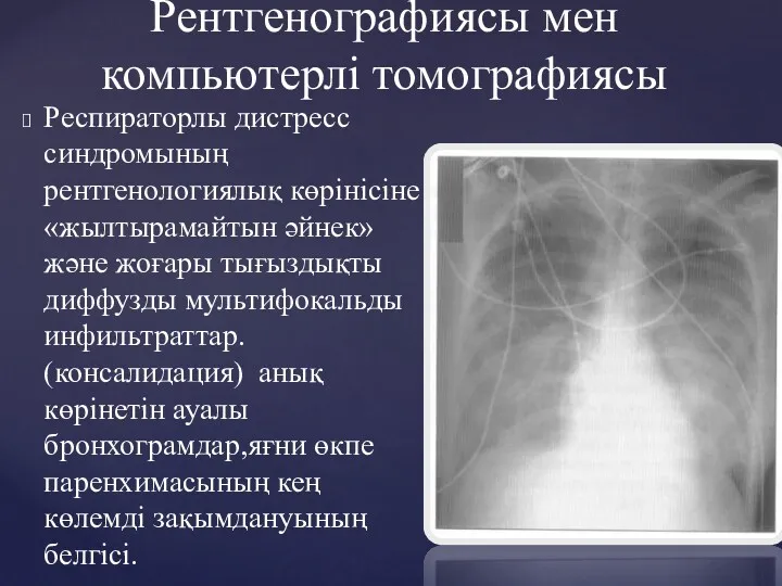 Рентгенографияcы мен компьютерлі томографиясы Респираторлы дистресс синдромының рентгенологиялық көрінісіне «жылтырамайтын