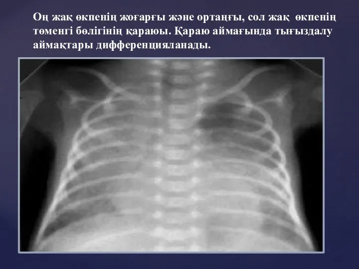 Оң жақ өкпенің жоғарғы және ортаңғы, сол жақ өкпенің төменгі