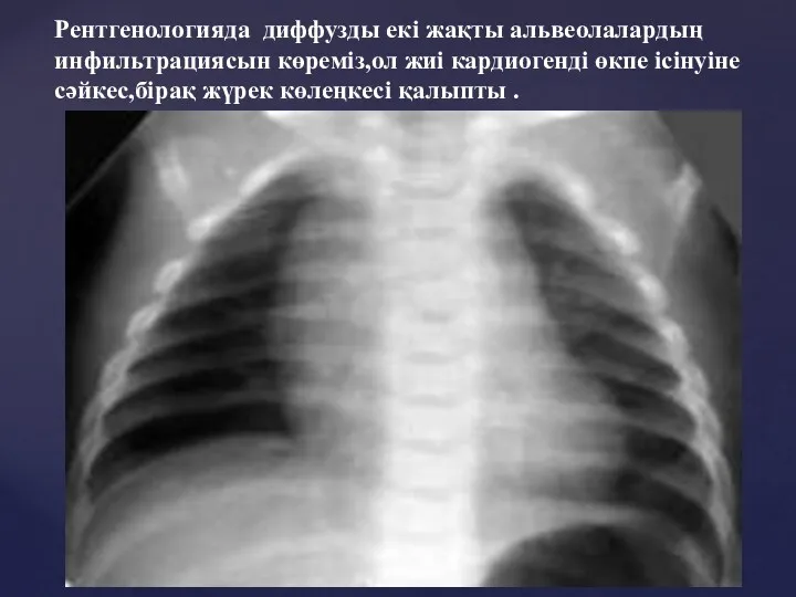 Рентгенологияда диффузды екі жақты альвеолалардың инфильтрациясын көреміз,ол жиі кардиогенді өкпе ісінуіне сәйкес,бірақ жүрек көлеңкесі қалыпты .