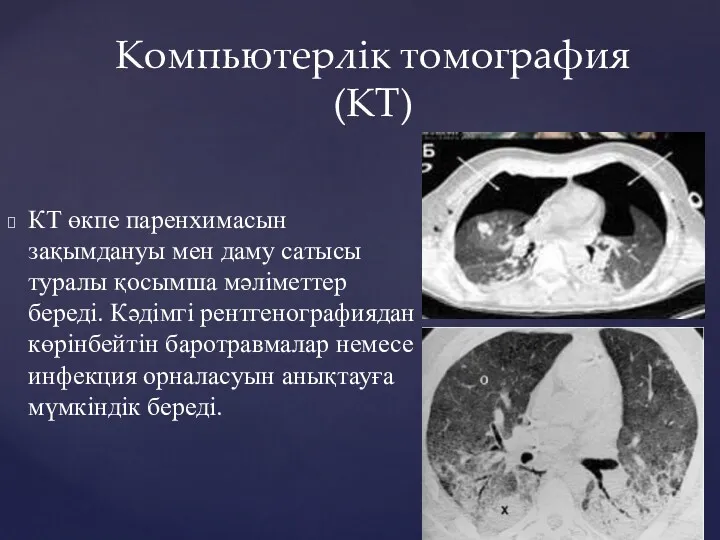 Компьютерлік томография (КТ) КТ өкпе паренхимасын зақымдануы мен даму сатысы