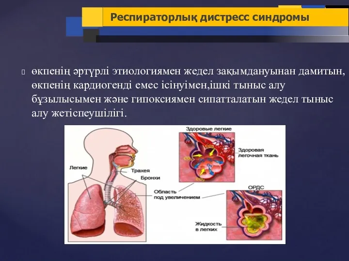 өкпенің әртүрлі этиологиямен жедел зақымдануынан дамитын,өкпенің кардиогенді емес ісінуімен,ішкі тыныс