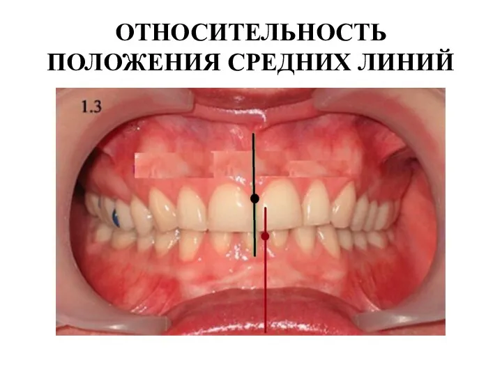 ОТНОСИТЕЛЬНОСТЬ ПОЛОЖЕНИЯ СРЕДНИХ ЛИНИЙ