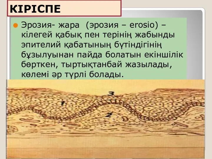 КІРІСПЕ Эрозия- жара (эрозия – erosio) – кілегей қабық пен терінің жабынды эпителий