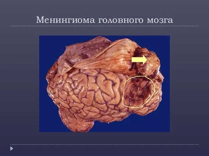 Менингиома головного мозга
