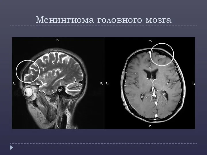 Менингиома головного мозга