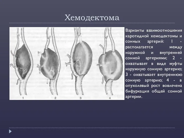 Хемодектома Варианты взаимоотношения каротидной хемодектомы и сонных артерий: 1 -