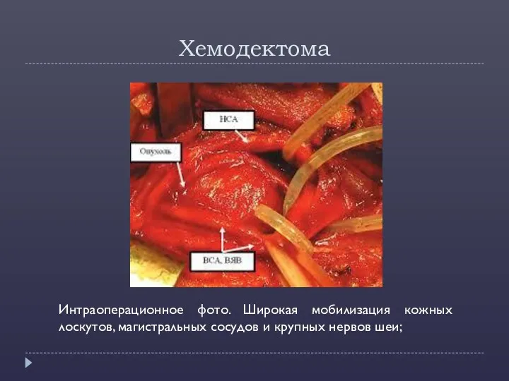 Хемодектома Интраоперационное фото. Широкая мобилизация кожных лоскутов, магистральных сосудов и крупных нервов шеи;