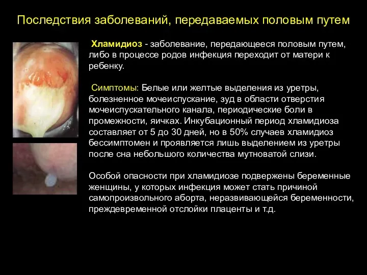 Последствия заболеваний, передаваемых половым путем Хламидиоз - заболевание, передающееся половым