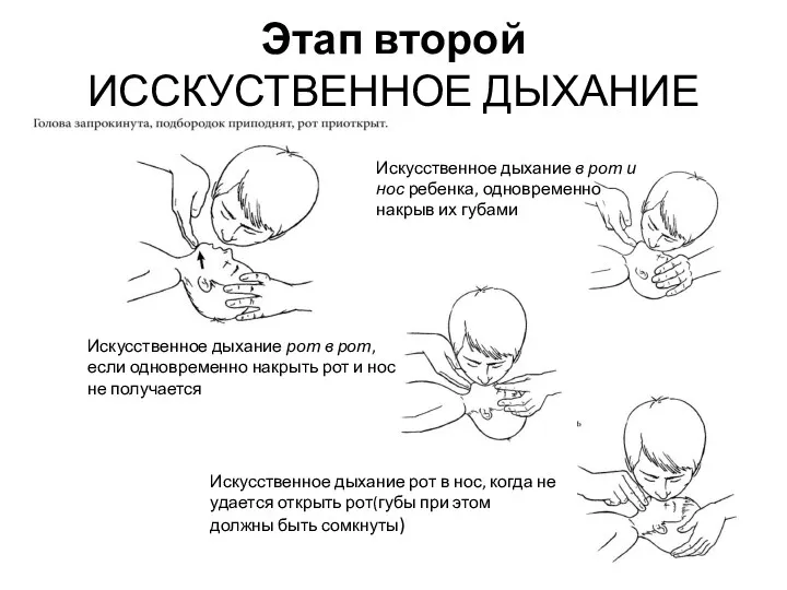 Этап второй ИССКУСТВЕННОЕ ДЫХАНИЕ Искусственное дыхание в рот и нос