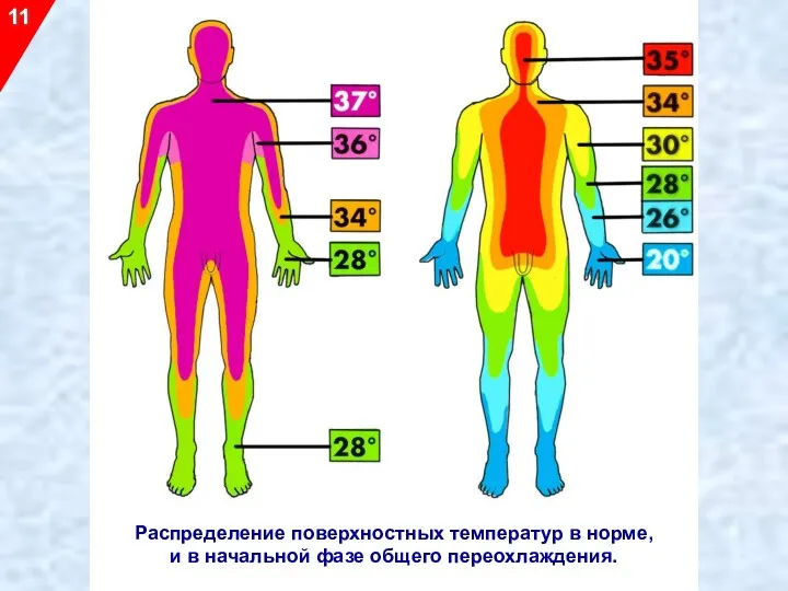 11 Распределение поверхностных температур в норме, и в начальной фазе общего переохлаждения.