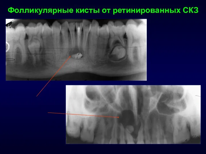 Фолликулярные кисты от ретинированных СКЗ