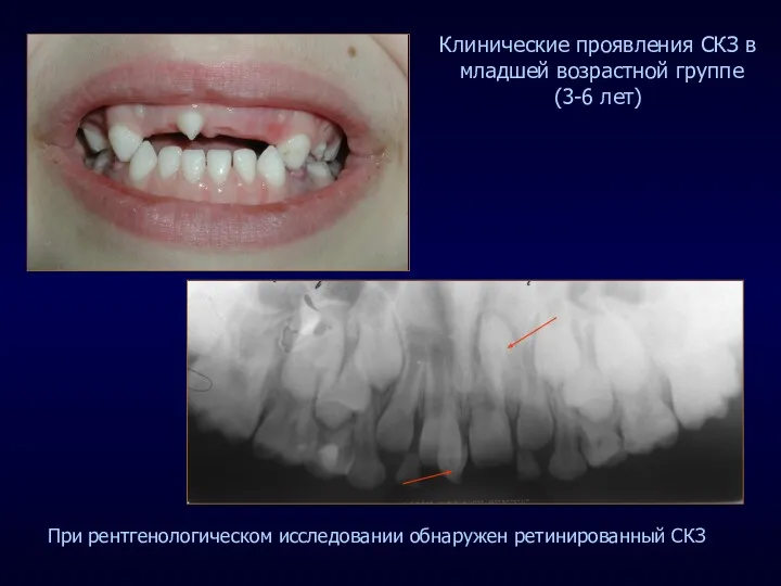 При рентгенологическом исследовании обнаружен ретинированный СКЗ Клинические проявления СКЗ в младшей возрастной группе (3-6 лет)