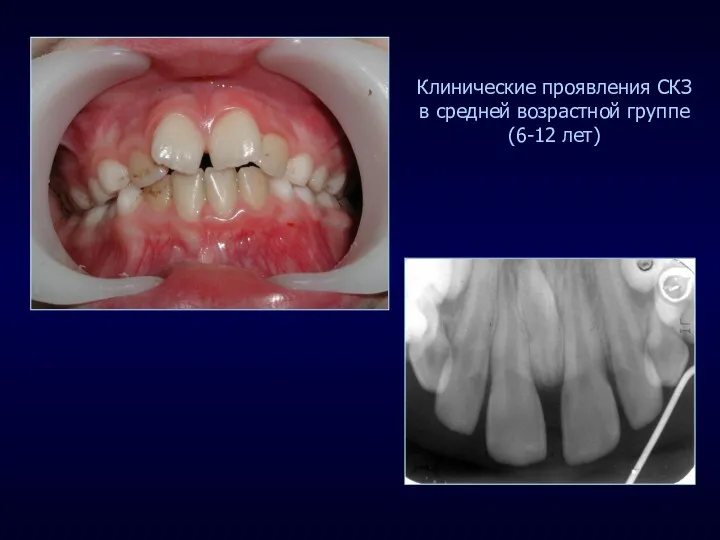 Клинические проявления СКЗ в средней возрастной группе (6-12 лет)