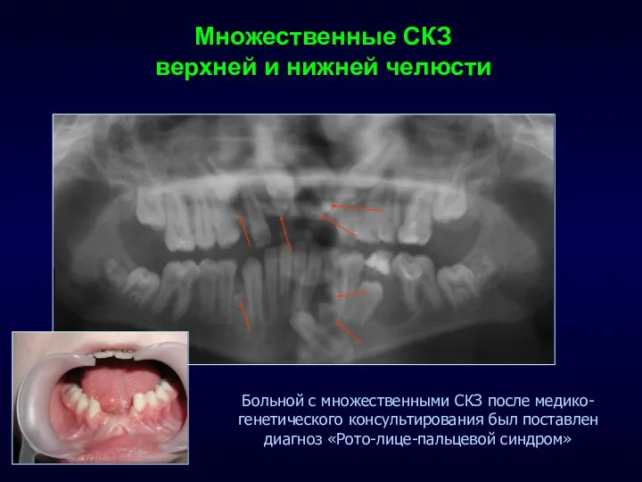 Множественные СКЗ верхней и нижней челюсти Больной с множественными СКЗ