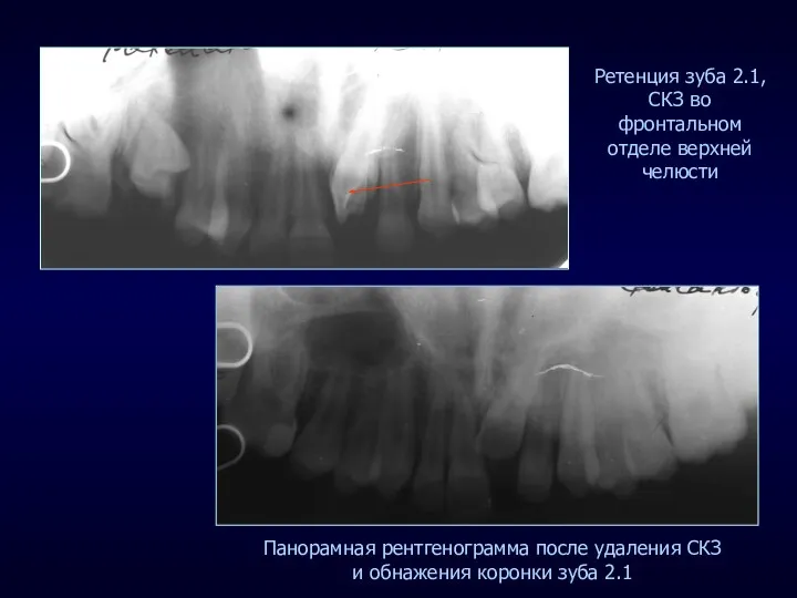 Ретенция зуба 2.1, СКЗ во фронтальном отделе верхней челюсти Панорамная