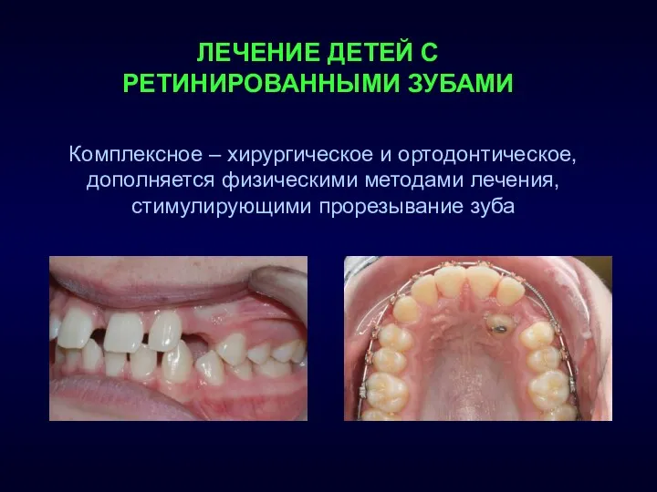 ЛЕЧЕНИЕ ДЕТЕЙ С РЕТИНИРОВАННЫМИ ЗУБАМИ Комплексное – хирургическое и ортодонтическое,