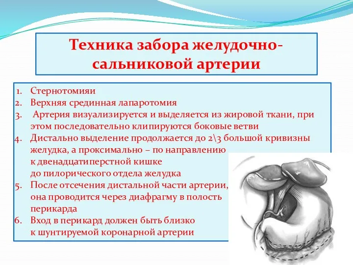 Техника забора желудочно-сальниковой артерии Стернотомияи Верхняя срединная лапаротомия Артерия визуализируется и выделяется из