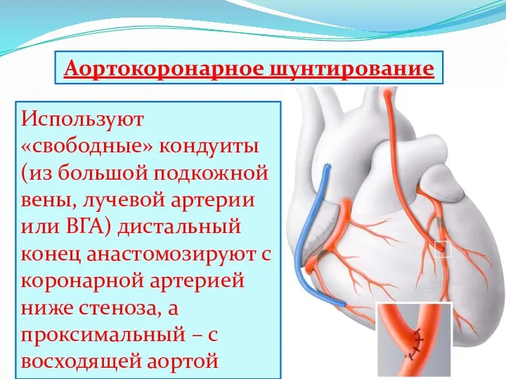 Аортокоронарное шунтирование Используют «свободные» кондуиты (из большой подкожной вены, лучевой артерии или ВГА)