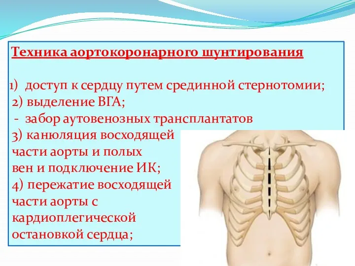 Техника аортокоронарного шунтирования доступ к сердцу путем срединной стернотомии; 2) выделение ВГА; забор