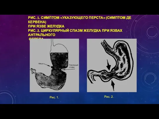 РИС. 1. СИМПТОМ «УКАЗУЮЩЕГО ПЕРСТА» (СИМПТОМ ДЕ КЕРВЕНА) ПРИ ЯЗВЕ