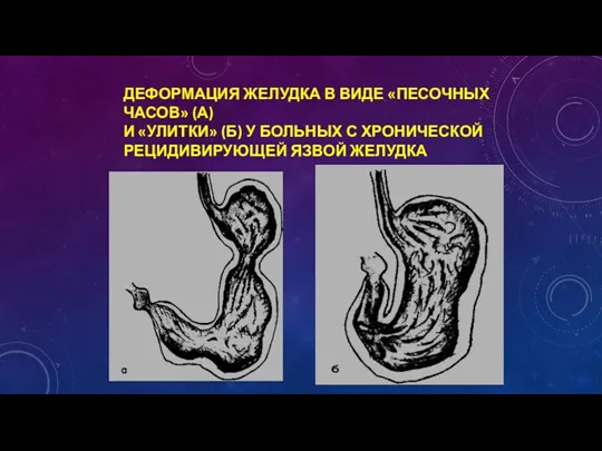 ДЕФОРМАЦИЯ ЖЕЛУДКА В ВИДЕ «ПЕСОЧНЫХ ЧАСОВ» (А) И «УЛИТКИ» (Б)