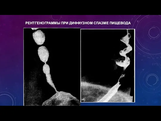 РЕНТГЕНОГРАММЫ ПРИ ДИФФУЗНОМ СПАЗМЕ ПИЩЕВОДА