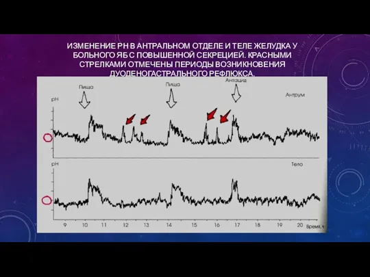 ИЗМЕНЕНИЕ РН В АНТРАЛЬНОМ ОТДЕЛЕ И ТЕЛЕ ЖЕЛУДКА У БОЛЬНОГО