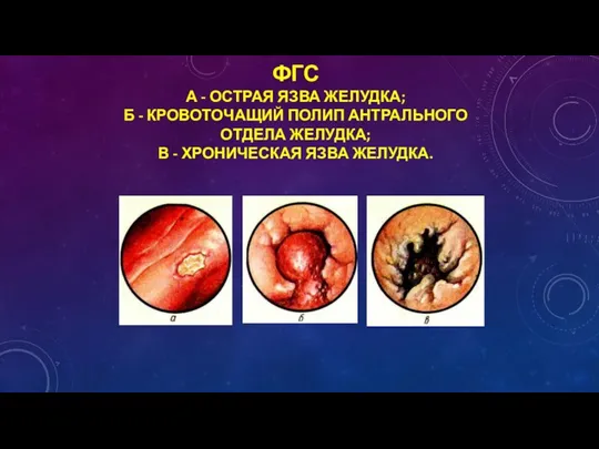 ФГС А - ОСТРАЯ ЯЗВА ЖЕЛУДКА; Б - КРОВОТОЧАЩИЙ ПОЛИП