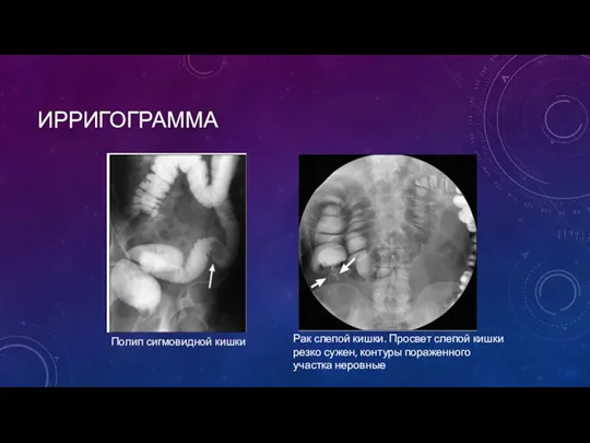 ИРРИГОГРАММА Полип сигмовидной кишки Рак слепой кишки. Просвет слепой кишки резко сужен, контуры пораженного участка неровные