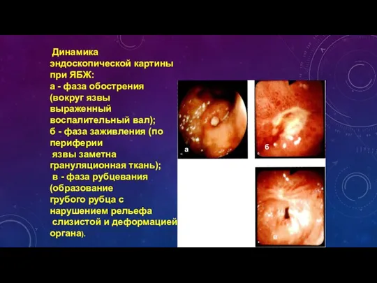 Динамика эндоскопической картины при ЯБЖ: а - фаза обострения (вокруг