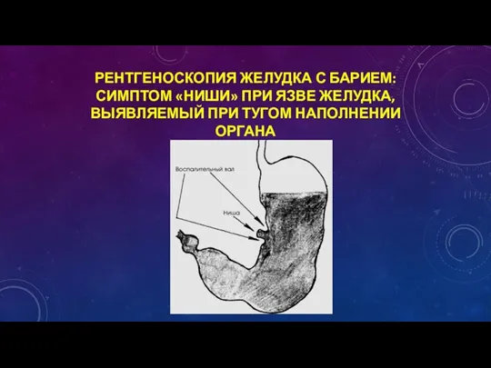 РЕНТГЕНОСКОПИЯ ЖЕЛУДКА С БАРИЕМ: СИМПТОМ «НИШИ» ПРИ ЯЗВЕ ЖЕЛУДКА, ВЫЯВЛЯЕМЫЙ ПРИ ТУГОМ НАПОЛНЕНИИ ОРГАНА