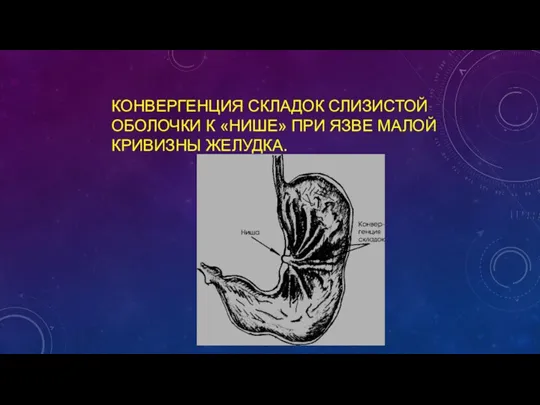 КОНВЕРГЕНЦИЯ СКЛАДОК СЛИЗИСТОЙ ОБОЛОЧКИ К «НИШЕ» ПРИ ЯЗВЕ МАЛОЙ КРИВИЗНЫ ЖЕЛУДКА.