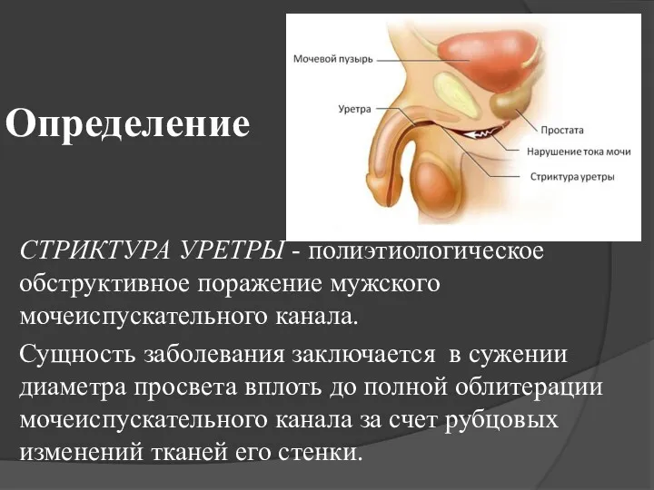 Определение СТРИКТУРА УРЕТРЫ - полиэтиологическое обструктивное поражение мужского мочеиспускательного канала. Сущность заболевания заключается