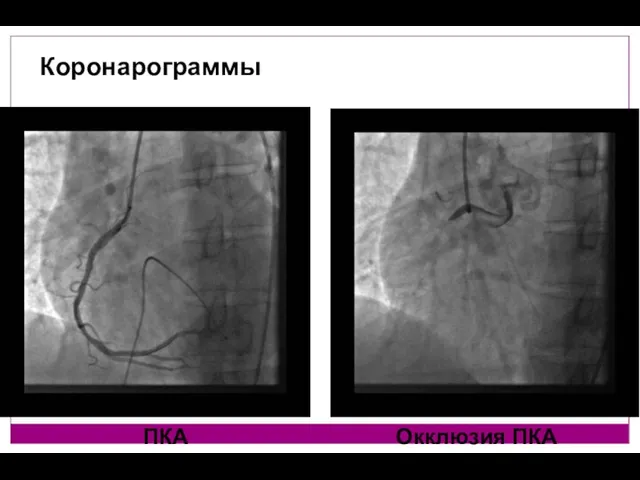 Коронарограммы ПКА Окклюзия ПКА