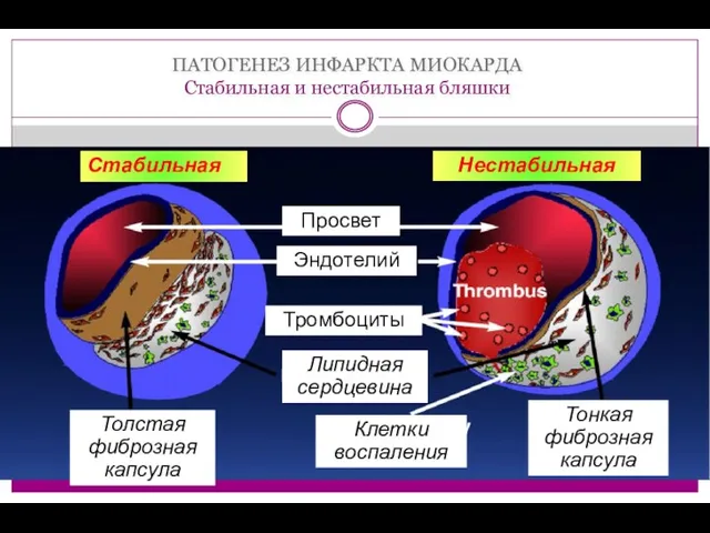 ПАТОГЕНЕЗ ИНФАРКТА МИОКАРДА Стабильная и нестабильная бляшки Стабильная Нестабильная Толстая