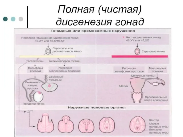 Полная (чистая) дисгенезия гонад