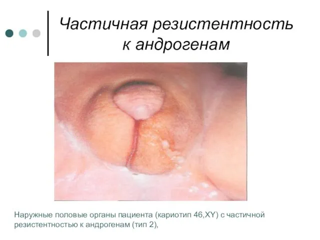 Частичная резистентность к андрогенам Наружные половые органы пациента (кариотип 46,XY)