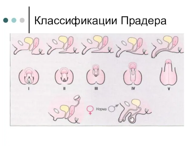 Классификации Прадера